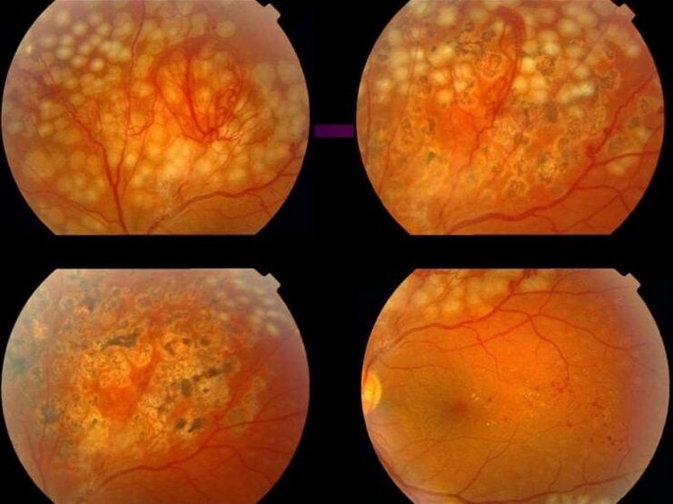 Retinopatie v důsledku hypertenze